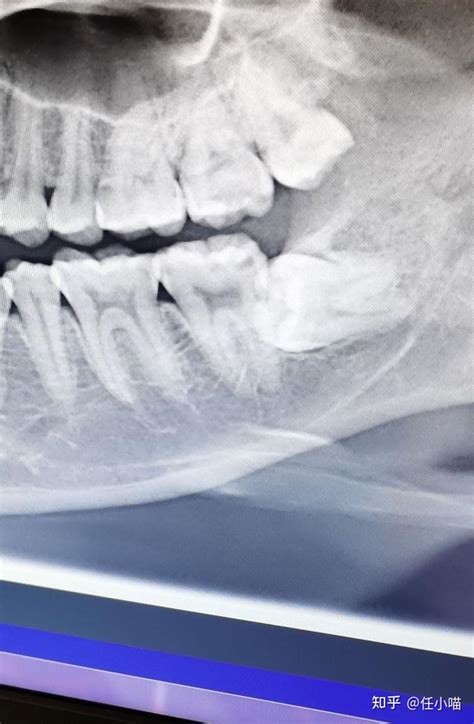 拔智齿是一种怎样的体验？拔智齿全过程及心得体验 知乎