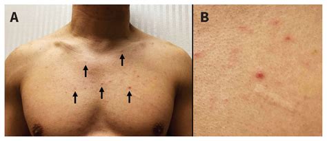 Infection Aigu Vih Chez Un Homme De Ans Cmaj