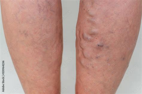 Varicose Veins In An Elderly Woman Inflamed Dilated Veins In The Legs