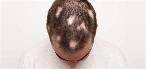 29+ alopecia areata haircut male - ParmjeetTiaami