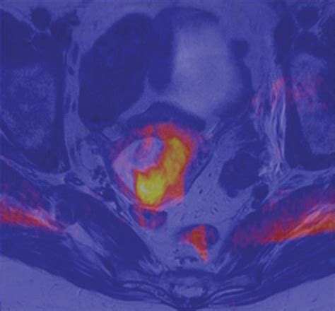 Diffusion Weighted Mr Imaging Of Female Pelvic Tumors A Pictorial