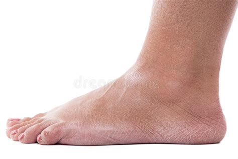 Dry Heels Woman On A White Background Closeup Stock Photo Image Of