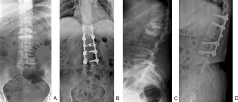 Osteomyelitis X Ray Spine