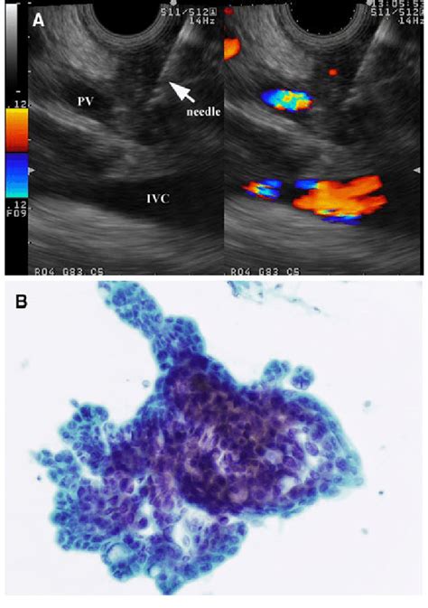 A Case Of Obstructive Jaundice Due To Bile Duct Tumor A Endoscopic