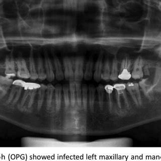 Orthopantomograph Showed Infected Left Maxillary And Mandibular Third