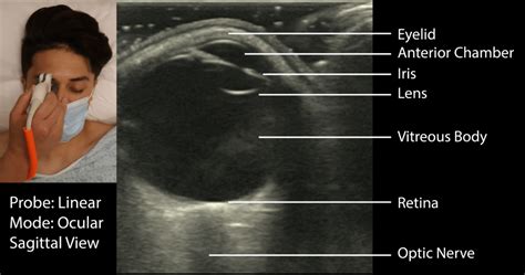 Eye Ultrasound