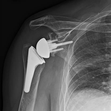 Dr McClintock S Shoulder X Ray Image Gallery Kyle McClintock DO