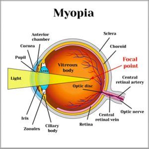 Myopia Smith Walker Opticians