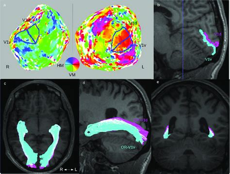 Fiber Tractography Of The Optic Radiation Or Overview Of The Download Scientific Diagram