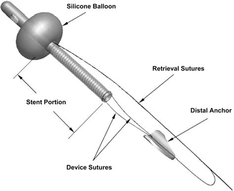 figure    temporary intraurethral prostatic stent relieves