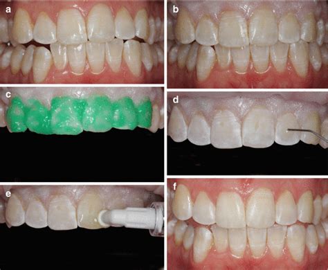 Resin Infiltration In White Spot Lesions Caused By