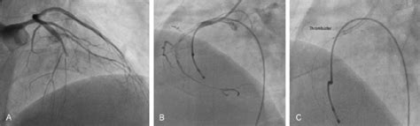 rheolytic thrombectomy system double vessel acute thrombotic occlusion