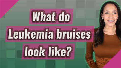 What Do Leukemia Bruises Look Like YouTube