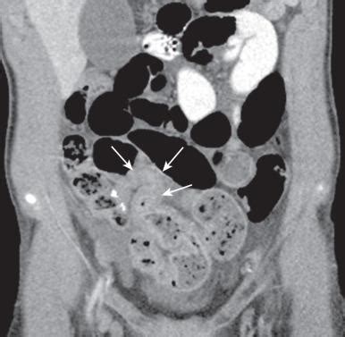 Acquired Lesions Of The Small Intestines Clinical Tree