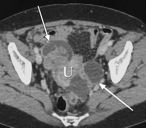 Multidetector Ct Of Peritoneal Carcinomatosis From Ovarian Cancer