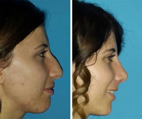 How To Get A Nose Job In Turkey A Complete Guide THEKITCHENTODAY