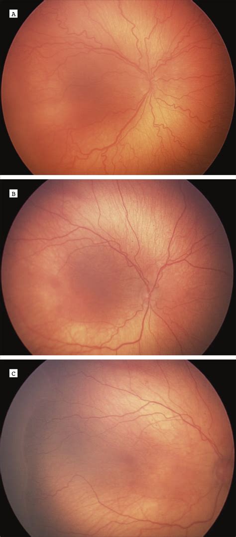 Telemedical Retinopathy Of Prematurity Diagnosis Neonatology JAMA