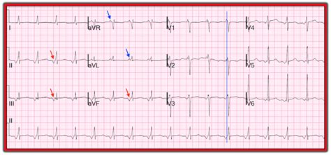 Dr Smith S Ecg Blog What Is Going On Here The Computer Called It