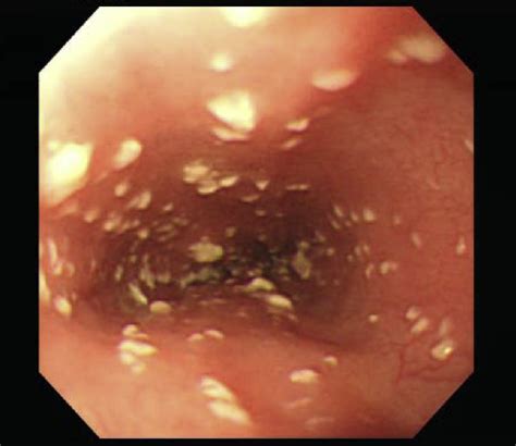 Endoscopic Images Of Esophageal Candidiasis Showed That Whitish Plaques