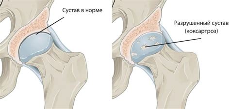 Симптомы и лечение коксартроза тазобедренного сустава - Доктор Позвонков