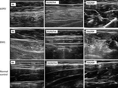 Frontiers Ultrasonography Of Abdominal Muscles Differential