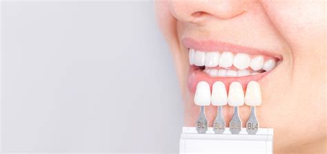 Dental Veneers London Aligners London