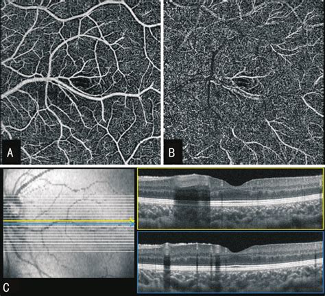 Optical Coherence Tomography Angiography Octa Images Of The Left Eye