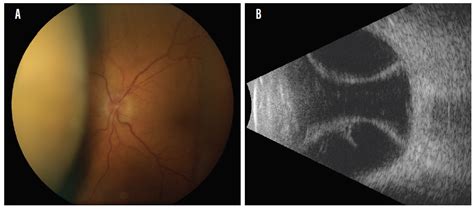 Choroidal Hemorrhage