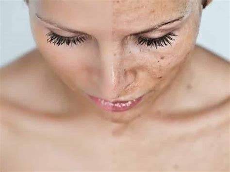 3 Types Of Chemical Peels To Know About Vk Skin Spa Brooklyn Ny