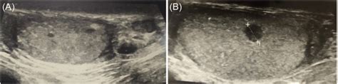 A Ultrasound Of Scrotum Showing Two Well Defined Solid Hypoechoic