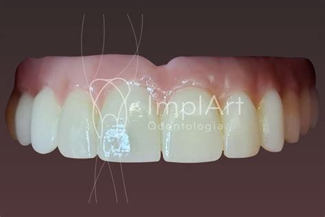 Protese Zirconia Total Fixa Implantes Antes E Depois 48kb ImplArt