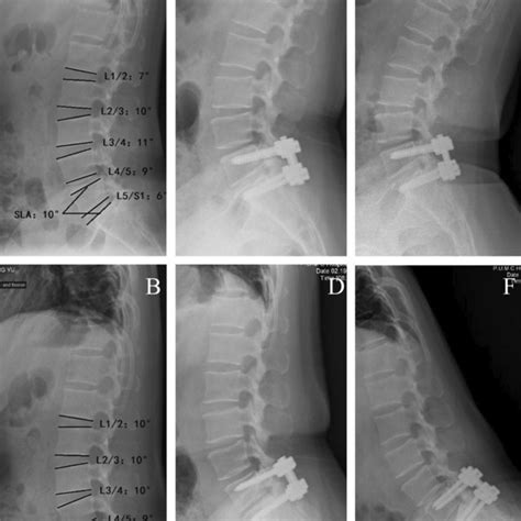 Preoperative And Immediate Postoperative Lateral Lumbar Radiograph A Download Scientific