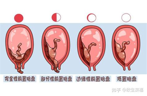 前置胎盘有4种，一张图带你秒懂 知乎