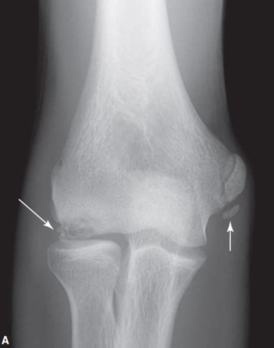 Elbow And Forearm Pathologies Flashcards Quizlet