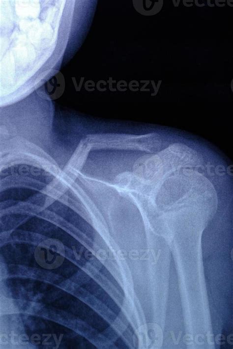 X-ray image broken collarbone person. 13105155 Stock Photo at Vecteezy