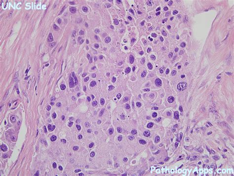 salivary duct carcinoma pathology