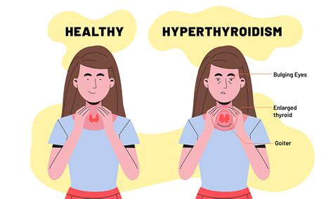 Hyperthyroidism Overactive Thyroid Symptoms Diagnosis 47 OFF