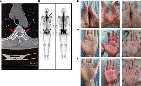 Frontiers Sapho Syndrome Complicated By Ankylosing Spondylitis Successfully Treated With