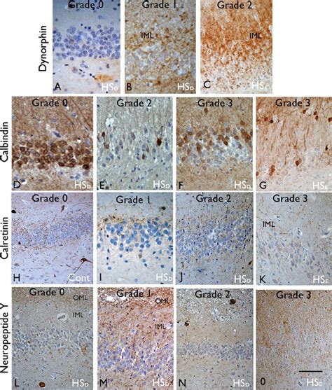 Dentate Gyrus Alterations In Hippocampal Sclerosis In Epilepsy Hse