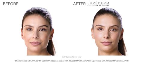 Juvederm Fillers At Laser Skin Institute Chatam New Jersey