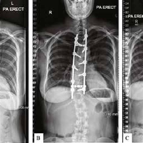 A Pre Operative Radiograph Of The Patient Showing Progressive