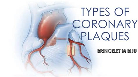 Types Of Coronary Plaques Slideshare Presentation Ppt