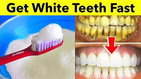 How To Get White Teeth At Home Without Baking Soda At Gregory Hines Blog