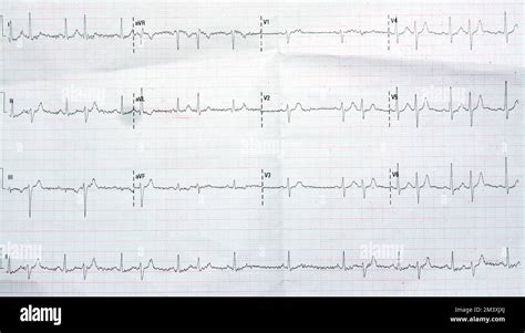 ECG ElectroCardioGraph Paper That Shows Normal Sinus Rhythm NSR With