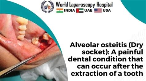 Alveolar Osteitis Dry Socket A Painful Dental Condition That Can