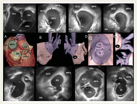 Figure From Electroanatomic Properties Of Pulmonary Vein Antral