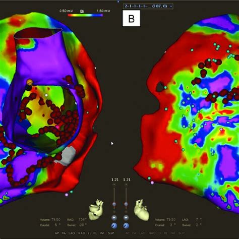 A A 3D CARTO Biosense Webster Diamond Bar CA Electroanatomic Map