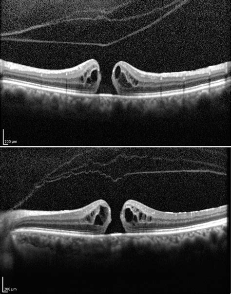 Posterior Vitreous Mobility Delineated By Tracking Of Optical Coherence