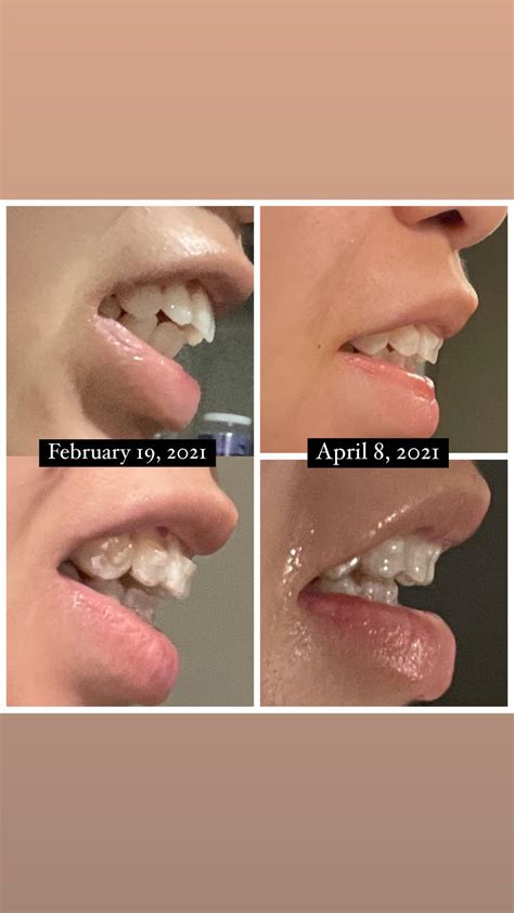 Started Invisalign Treatment February 3 2021 Open Bite Progress After