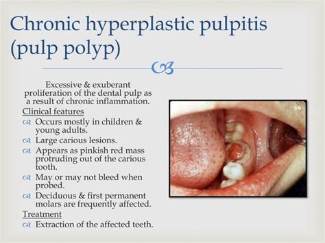 Pulpal Periapical Diseases Ppt